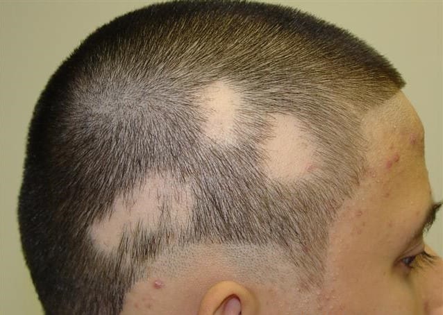 Alopecia